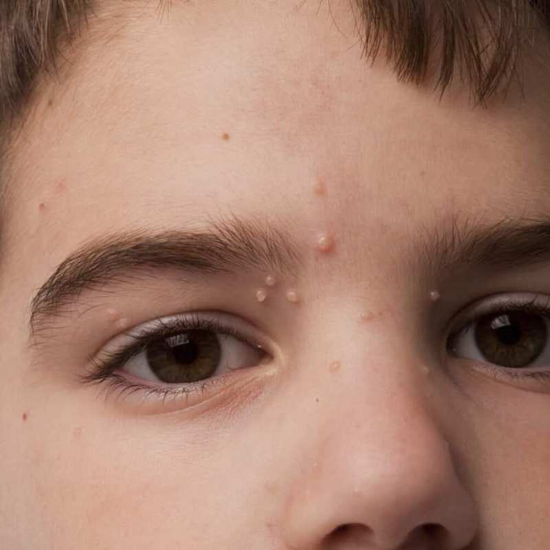 MOLLUSCUM CONTAGIOSUM REMOVAL