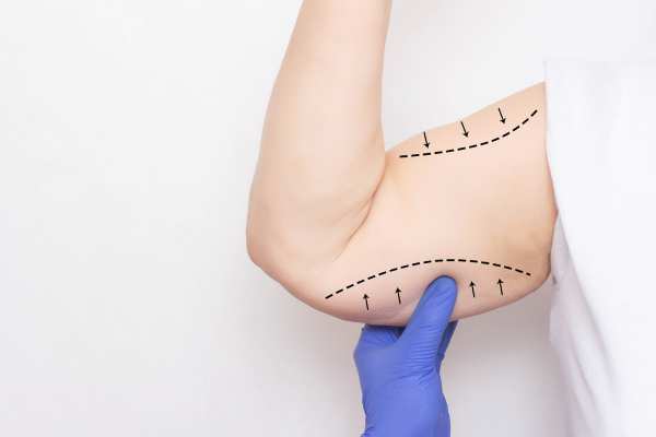 Arm toning treatment Cumbernauld  from lipo Sculpt!
