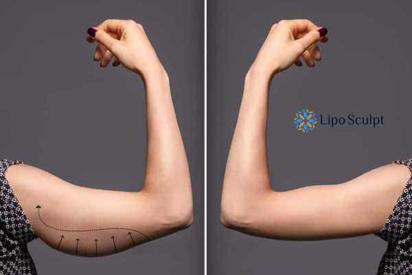 HIFU to reduce and tone sagging skin and fat on the arms from Lipo Sculpt Cumbernauld 