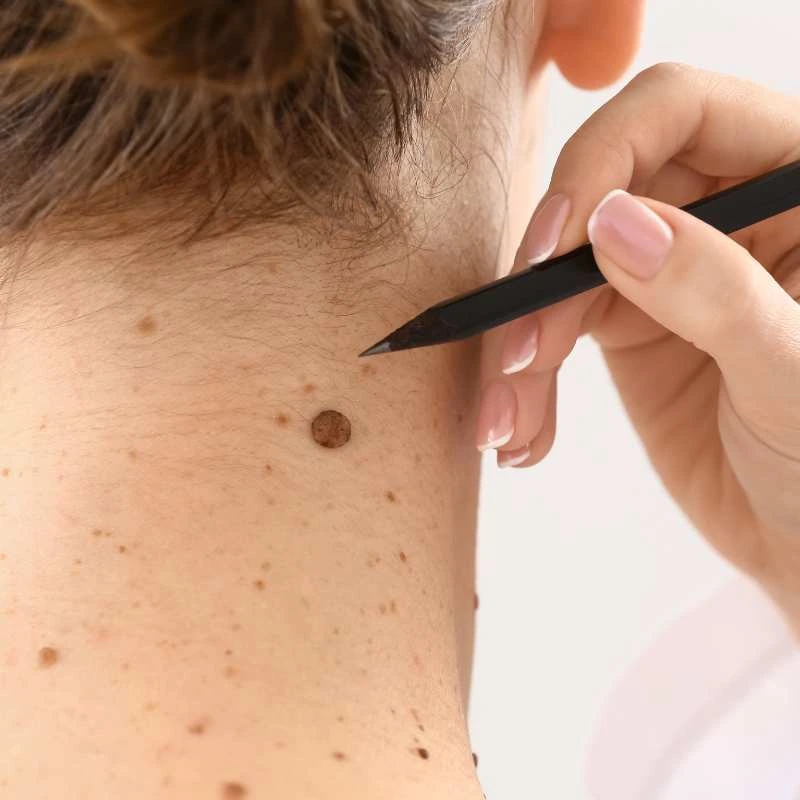 See our lesion removal prices Cumbernauld  - call today for a free quote
