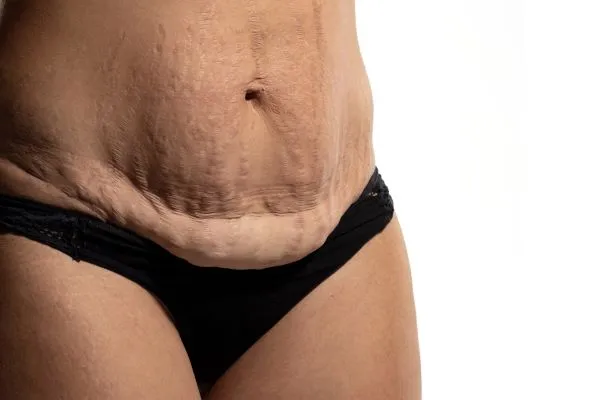 image of womans stomach after weight loss showing loose skin Cumbernauld  
