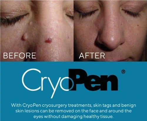 image of angiofibroma removal Cumbernauld  using Lipo Sculpt cryopen!
