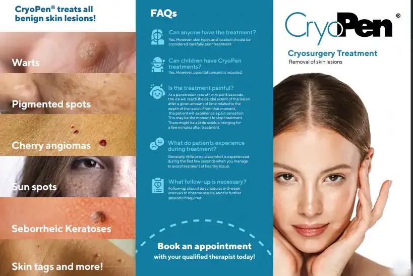 Benefits of Cryopen for seborrheic keratosis Removal Treatment Cumbernauld 