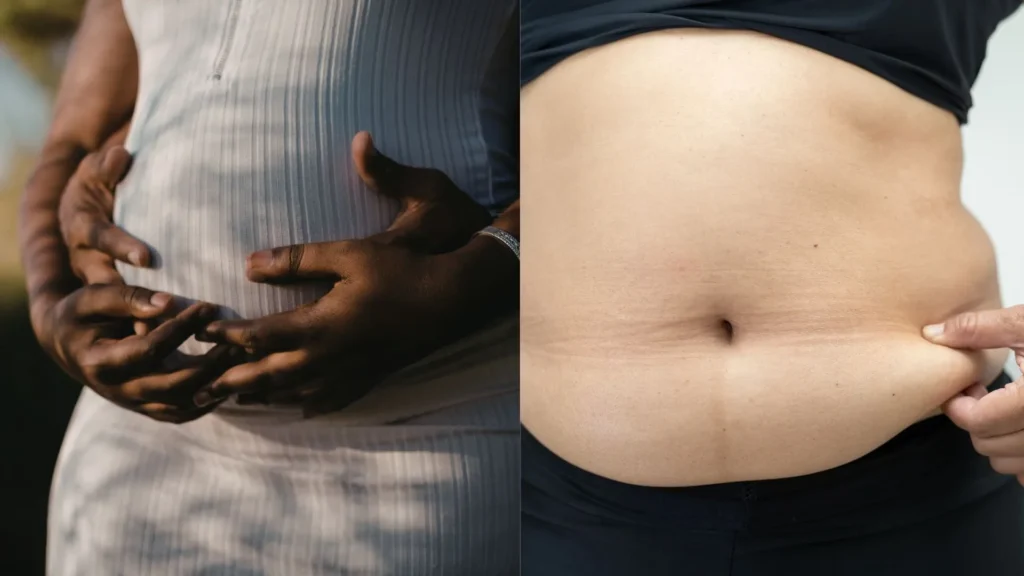 When a Belly Band Genuinely Makes Sense in Case of Diastasis Recti