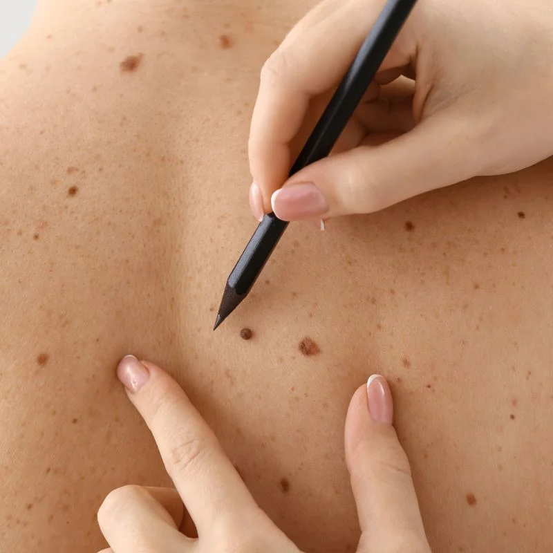 cryopen lesion removal treatment Cumbernauld 