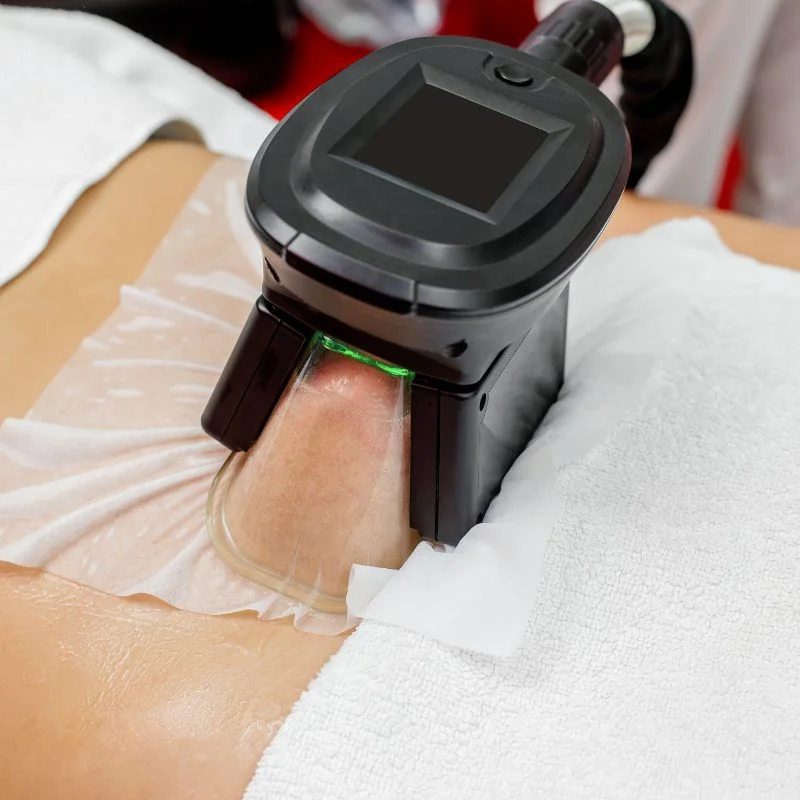 Fat Freezing treatment Cumbernauld 