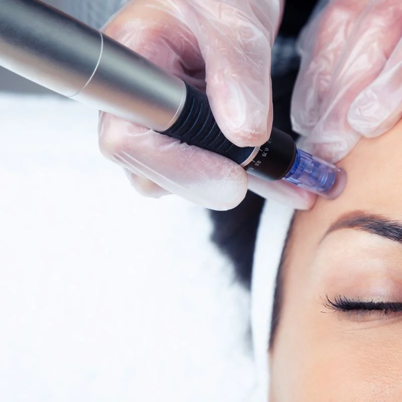 tightening treatment Cumbernauld 